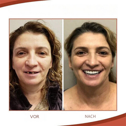 Ensemble de prothèses dentaires en silicone biocompatible pour un ajustement indolore et un sourire naturel
