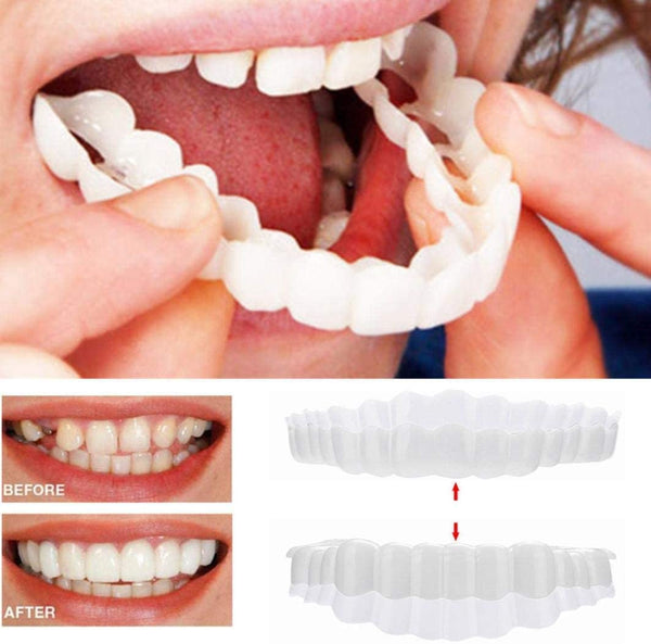 Facettes dentaires (haut et bas inclus)