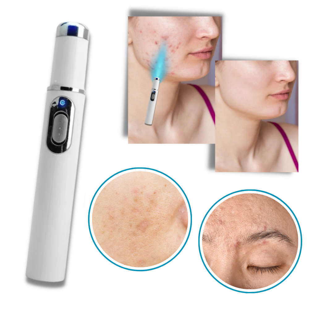 Stylo laser bleu pour un teint plus uniforme