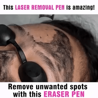 Stylo laser picoseconde effaceur d’imperfections de la peau